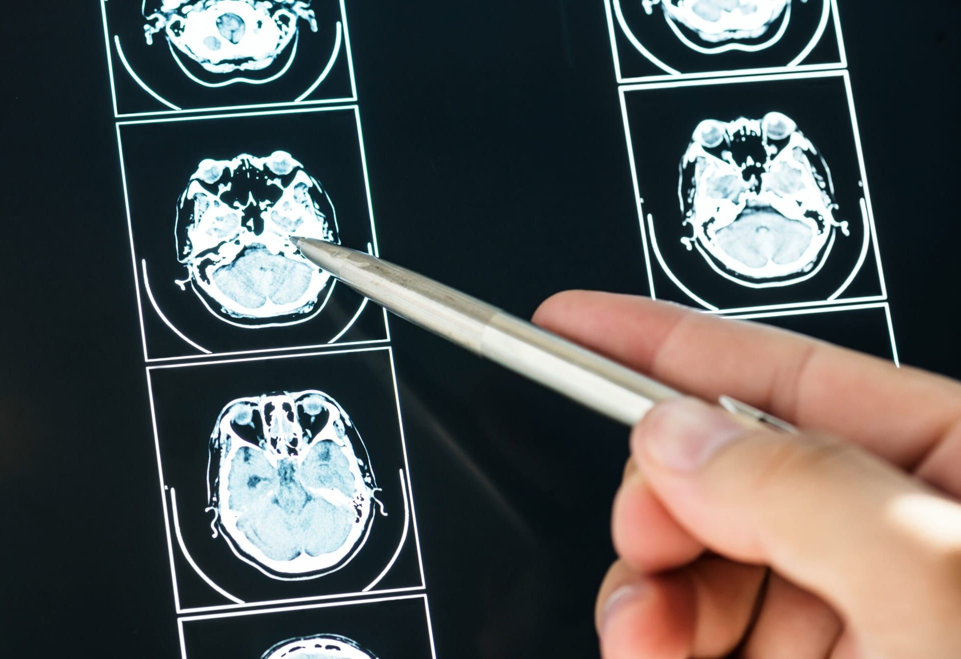Breakthroughs in Brain Health: Home Therapies and Surprising Drug Links Lead the Way